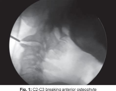 Figure 1 From Dysphagia Caused By Anterior Cervical Osteophytes At C2 C3 Unusual Location And