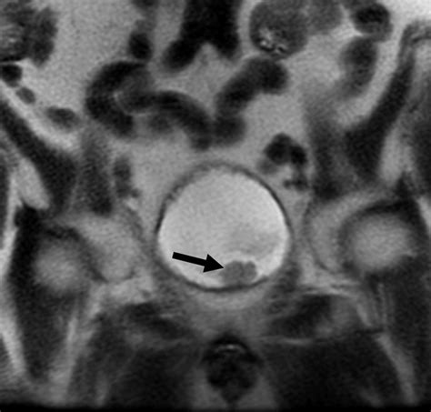 Mr Urography Techniques And Clinical Applications Radiographics