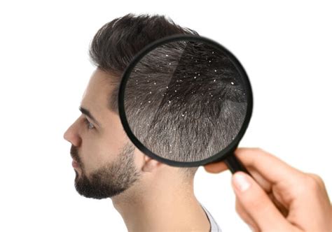 Can Dandruff Cause Hair Loss Hair Doctors Sydney