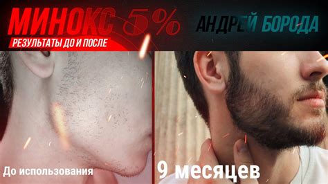 Миноксидил результаты До и После. Андрей Борода Выпуск №21 Как ...