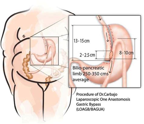 Everyhing About Mini Gastric Bypass Surgery Op Dr Murat St N