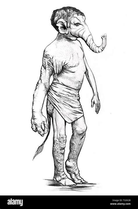 Proteus Syndrome Elephant Man