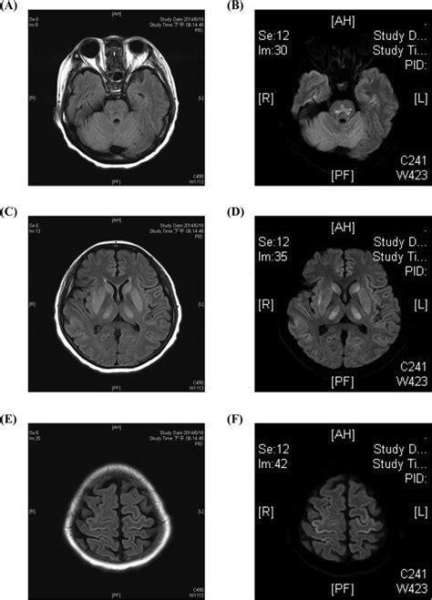 T2 Flair Left And Dwi Right Mri Symmetrically Hyperintense Signals