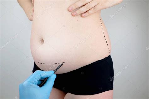 Abdominoplastia Y Torsoplast A Liposucci N Abdominal Y Extirpaci N Del