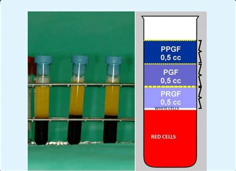 The Blood Tube After Centrifugation Shows Layers The Lower Red Layer