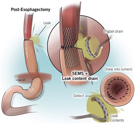 Novel Techniques For The Management Of Esophageal Anastomotic Leaks