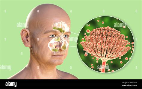 Aspergillus Fungi As A Cause Of Sinusitis Computer Illustration