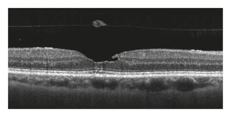 Multimodal Imaging Of Lamellar Macular Hole A Structural Optical