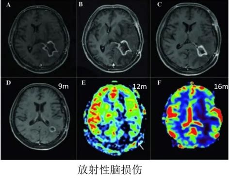 干货分享 如何从mr判断是胶质瘤复发，还是放射性脑损伤？脑损伤复发胶质瘤 健康界