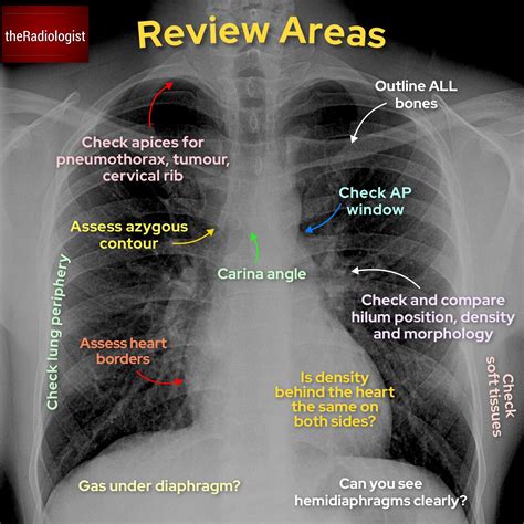 How To Read Chest X Ray Chest X Ray Anatomy Chest X Ray Pa View | The ...