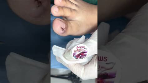 Ep4376 Ingrown Toenail Removal 👣 รอยค้ำที่นิ้วเกิดได้ยังไงครับ 😁