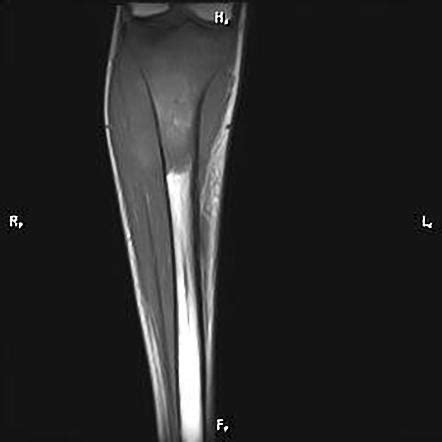 Osteosarcoma Image Radiopaedia Org