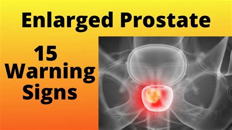 Enlarged Prostate 15 Warning Signs Bph Signs And Symptoms 2020 Youtube