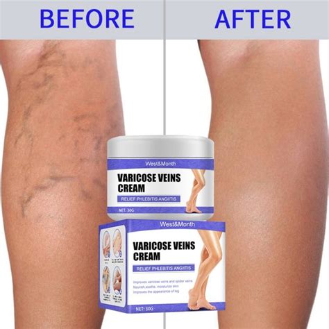 Effective Varicose Veins Relief Cream Relieve Vasculitis Phlebitis Spider Pain Treatment