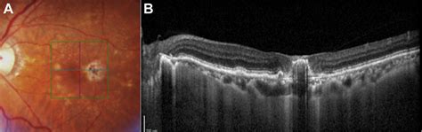 Retinal Angiomatous Proliferation Survey Of Ophthalmology