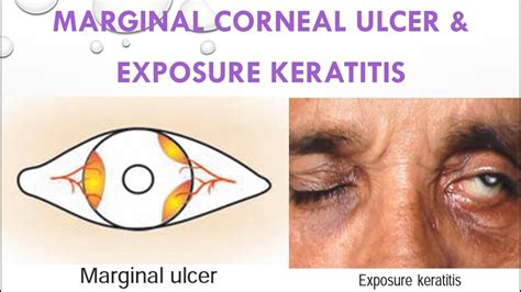 Marginal Corneal Ulcer Exposure Keratitis Keratitis Part Youtube