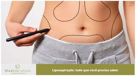 Lipoaspiração Tudo que você precisa saber