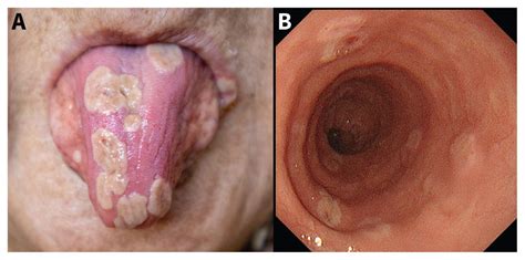 Glossitis And Esophagitis From Herpes Simplex Virus Type 1 Infection CMAJ