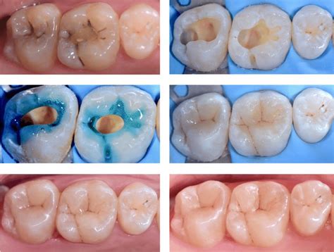 Shows Two Decayed Teeth Class I Cavities In 16 And 17 And The