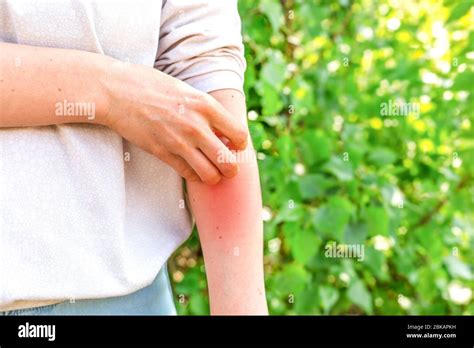 Skin Allergy The Concept Of Dermatitis And Scabies A Woman Scratches