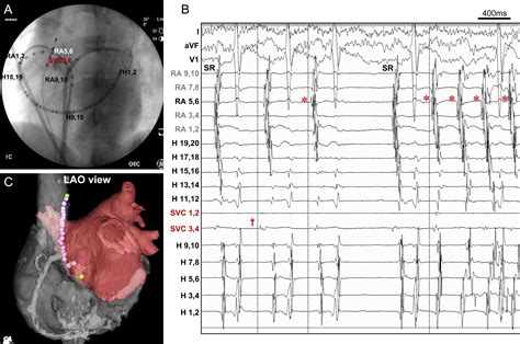 References In Catheter Ablation For Cold Water Swallowinginduced Paroxysmal Atrial Fibrillation