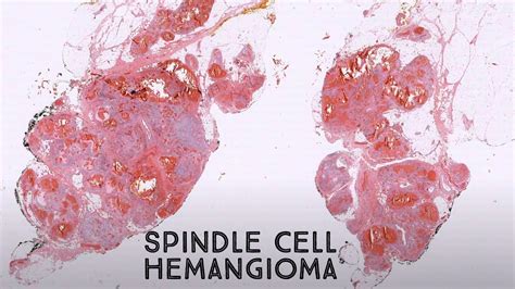 Spindle Cell Hemangioma Pathology Dermpath Dermatology