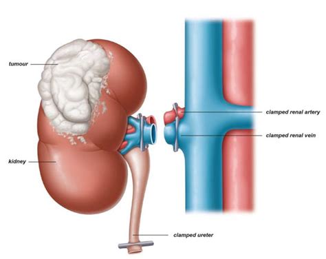 Right Nephrectomy | Tirath Ram Shah Hospital