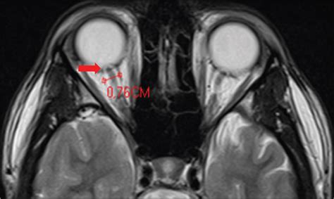 Scielo Brasil Idiopathic Intracranial Hypertension An Illustrated