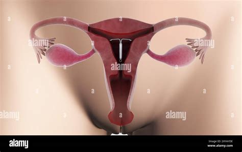 Biomedical Illustration Of An Intrauterine Device In Position Inside