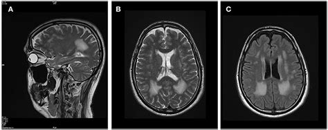 Frontiers Evidence Of Two Novel Lama2 Variants In A Patient With