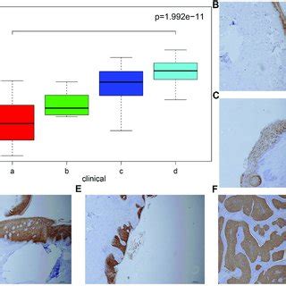 A The Expression Of Kntc Of Normal Cervix Cervical Precancerous