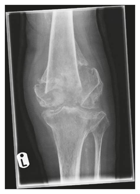 A AP And B Lateral Radiographs Demonstrating Ongoing Nonunion And