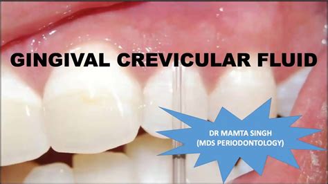 Dr Mamta Singhs Online Perio Lecture On The Topic Gingival Crevicular