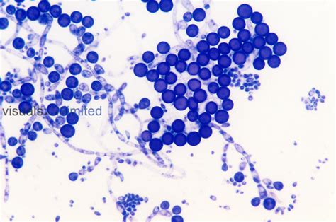 Yeast Candida Albicans Hyphae Chlamydospores And Blastospores Lm