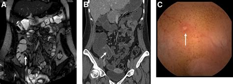 Diagnostic Accuracy Of Capsule Endoscopy For Small Bowel Crohn S