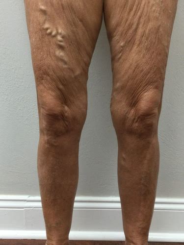 Before After Fort Myers Vein Specialists