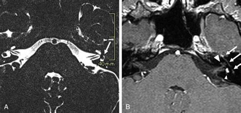 Temporal Bone Tumors Radiology Key