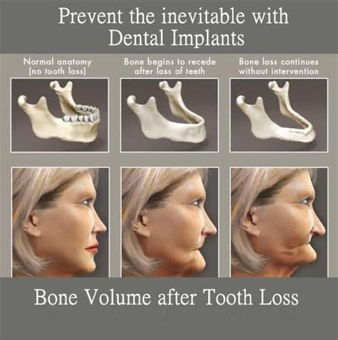 Losing Teeth Causes Bone Loss and Bite Collapse