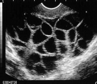 Ultrasound And Ovarian Hyperstimulation Syndrome Radiology Key