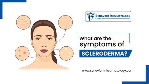 What are the Symptoms of Scleroderma? | 16 Major Symptoms 2022