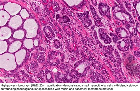 Pathology Outlines Adenoid Cystic Carcinoma