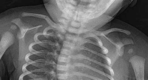 Transverse Morphology Of Clavicle Fracture Download Scientific Diagram