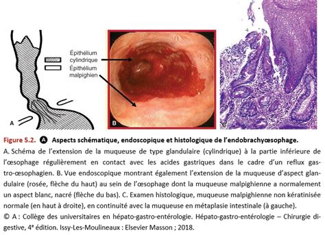 Société Française de Pathologie II b Pathologie digestive Tube digestif