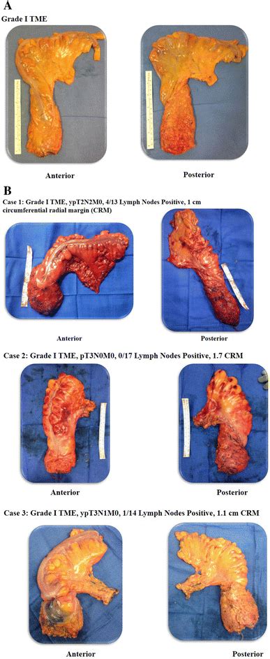 Total Mesorectal Excision