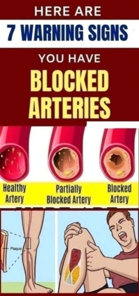 Clogged Arteries Schematic Diagram Atherosclerosis Heart Blo