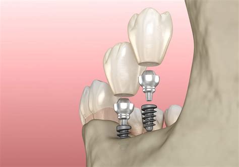 Mini implants - Next Smile