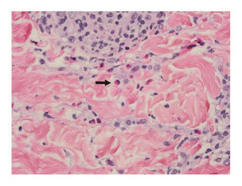 Skin Biopsy Demonstrating A Perivascular And Interstitial Download