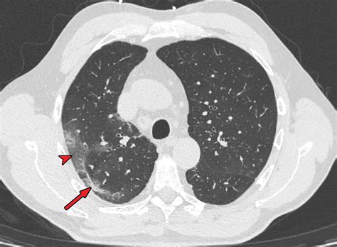 Chest CT In COVID 19 What The Radiologist Needs To Know RadioGraphics