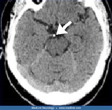 Basilar Artery Stroke Medlink Neurology