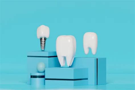 Lo Que Necesita Saber De Los Implantes Dentales P P Clinic